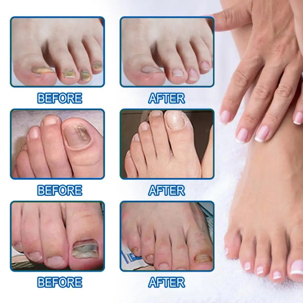 Nail Fungus Care Solution Anti-Infection Onychomycosis Repair Damaged Cracked Hand Foot Nail Manicureed Health Care Essence