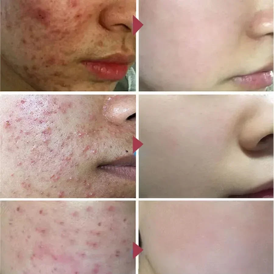 Salicylic Acid Acne Treatment Face Cream Repair Pimple Spots Deep Cleaning Pore Anti-acne Scar Oil Control Moisturizer Skin Care