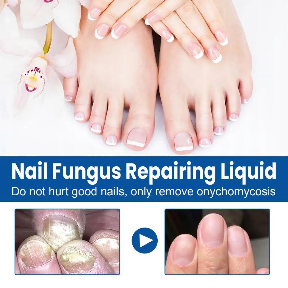 Nail Fungus Care Solution Anti-Infection Onychomycosis Repair Damaged Cracked Hand Foot Nail Manicureed Health Care Essence