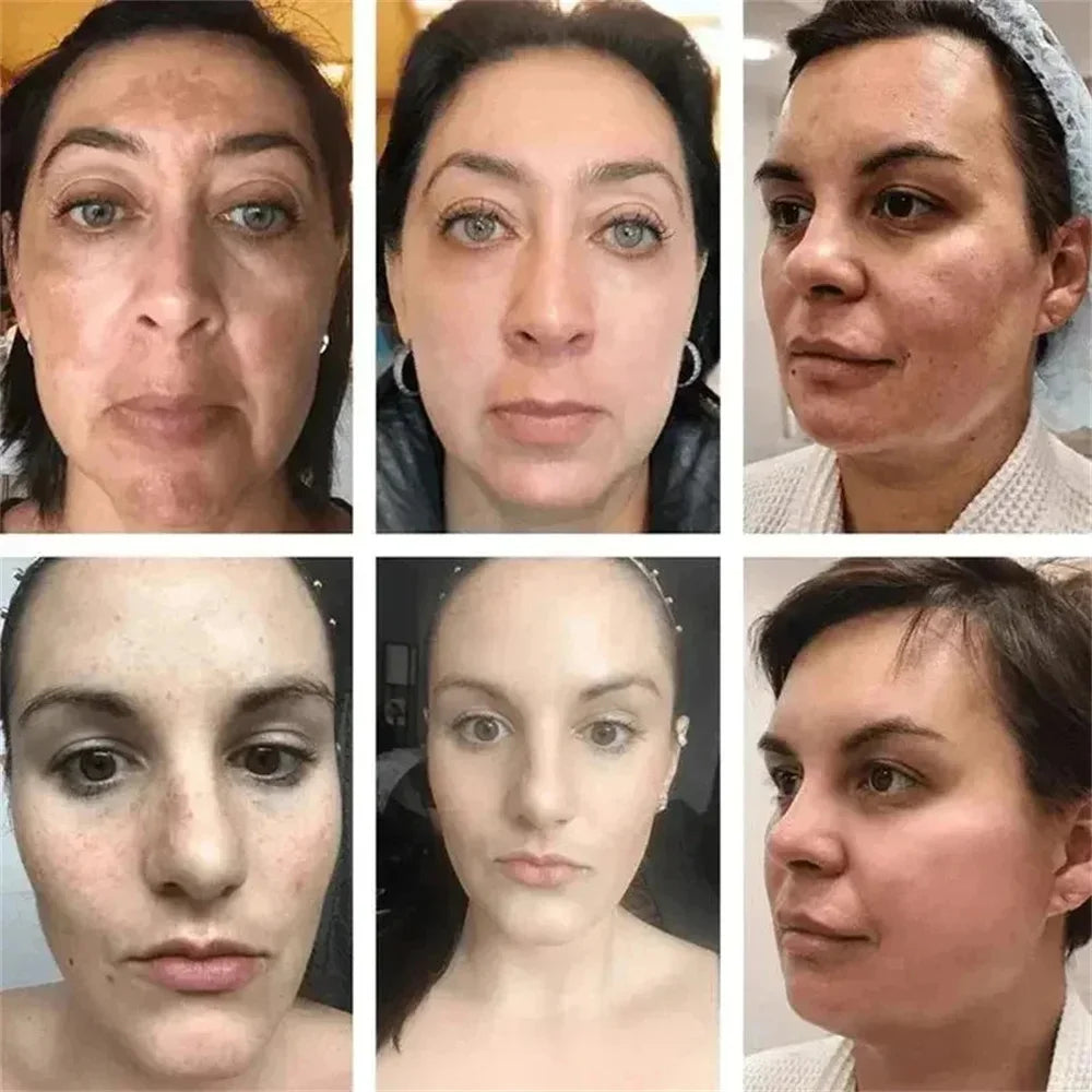 Powerful Spot-Removing Whiten Cream Brighten Skin Fast Eliminates Melanin Pigmentation Melasma Dark Spots Korean Face Skin Care