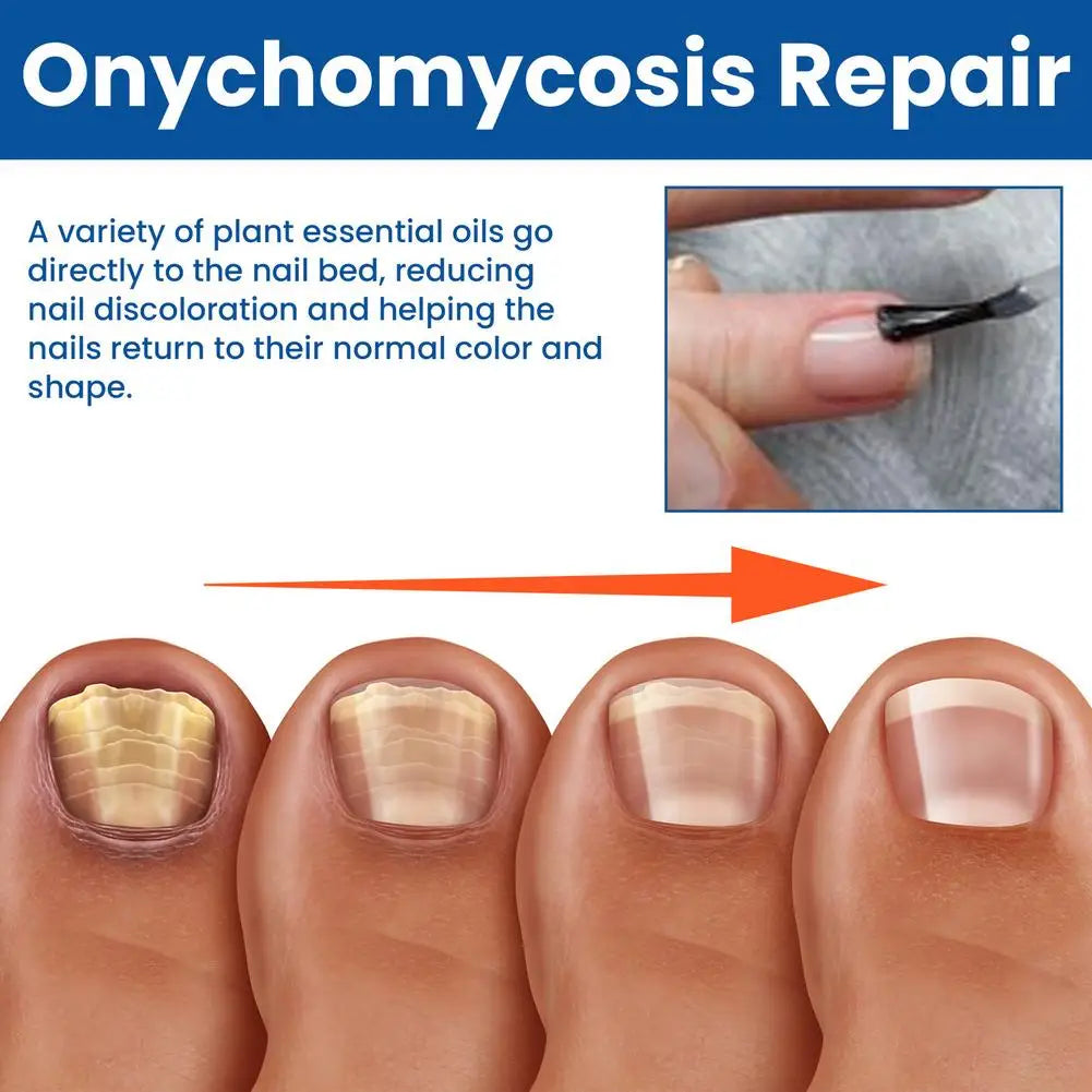 Nail Fungus Care Solution Anti-Infection Onychomycosis Repair Damaged Cracked Hand Foot Nail Manicureed Health Care Essence
