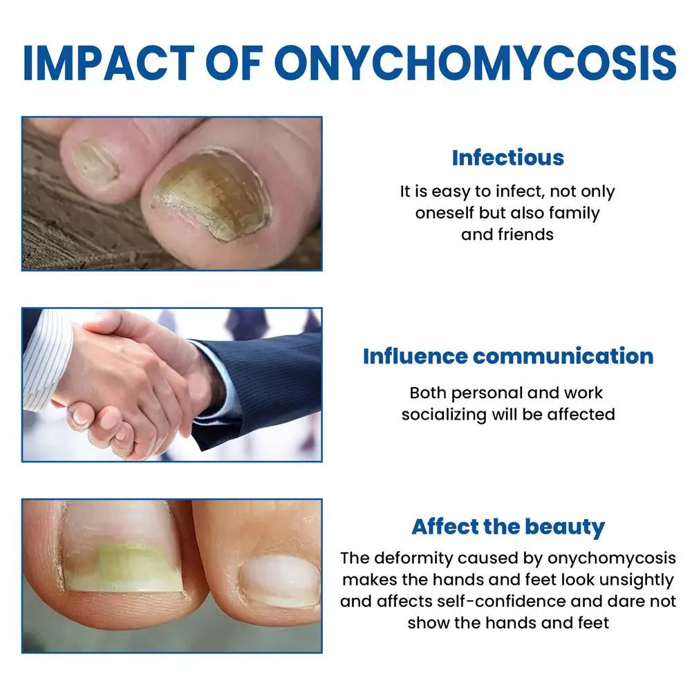 Nail Fungus Care Solution Anti-Infection Onychomycosis Repair Damaged Cracked Hand Foot Nail Manicureed Health Care Essence
