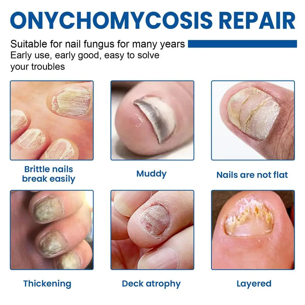 Nail Fungus Care Solution Anti-Infection Onychomycosis Repair Damaged Cracked Hand Foot Nail Manicureed Health Care Essence