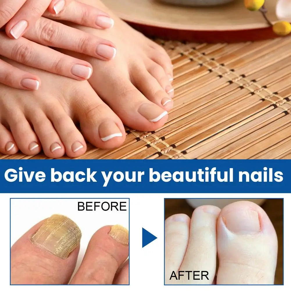 Nail Fungus Care Solution Anti-Infection Onychomycosis Repair Damaged Cracked Hand Foot Nail Manicureed Health Care Essence